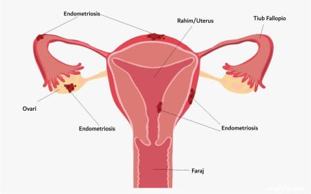 endometriosis