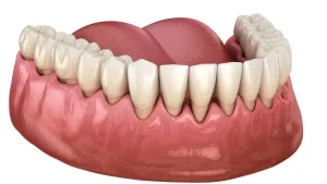gingivitis