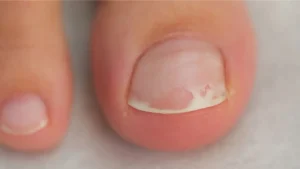 onikolisis