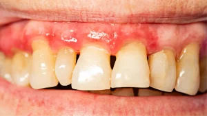 periodontitis