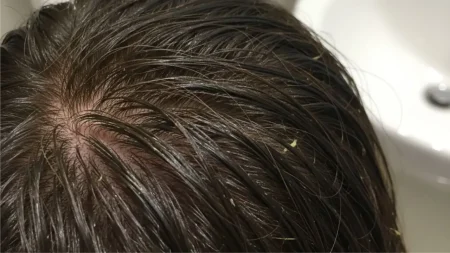 kulit kepala berminyak