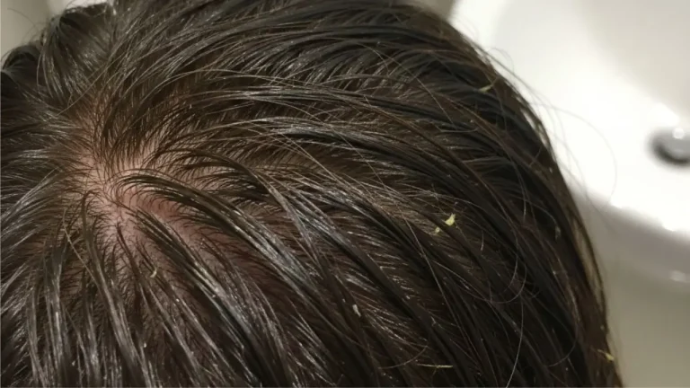 kulit kepala berminyak