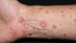 Liken Planus (Lichen Planus): Kenali Punca, Gejala dan Pilihan Rawatan liken planus