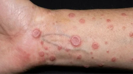 Liken Planus (Lichen Planus): Kenali Punca, Gejala dan Pilihan Rawatan liken planus