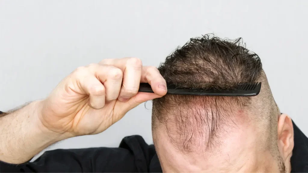 ubat GLP-1 rambut gugur