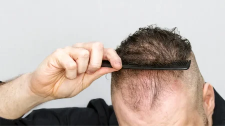 Kajian Baharu Temui Ubat GLP-1 Seperti Ozempic dan Mounjaro Mungkin Tingkatkan Risiko Rambut Gugur ubat GLP-1 rambut gugur