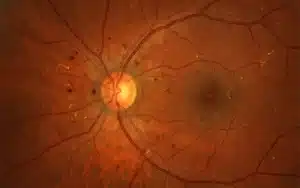 Retinopati Diabetes: Simptom, Punca, Tahap, Rawatan dan Cara Mencegah Kehilangan Penglihatan retinopati diabetes