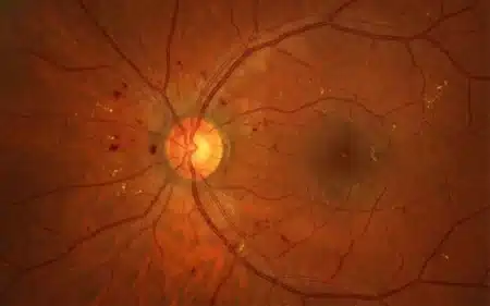 Retinopati Diabetes: Simptom, Punca, Tahap, Rawatan dan Cara Mencegah Kehilangan Penglihatan retinopati diabetes