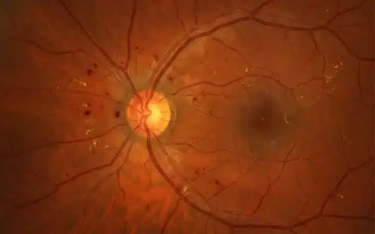 retinopati diabetes
